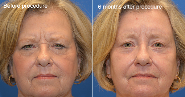 wrinkles acne How to remove wrinkles and Acne